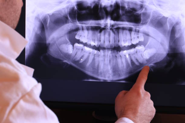 Best Emergency Dentist for Lost Fillings or Crowns in Monroe, UT